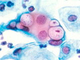 Vue au microscope d'une bactérie Chlamydia