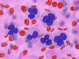 Cellules de lymphome dans le sang