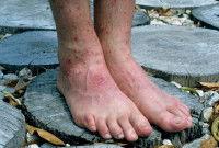 Des pieds avec des morsures causées par des aoûtats