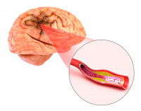 Schéma d'un AVC dans un cerveau