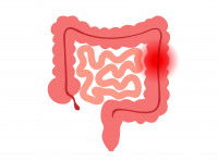 Un schéma des intestins avec une inflammation