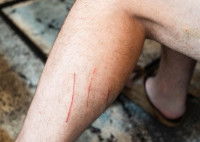 Des traces de griffures sur une jambe